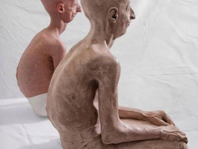 Avance alentador en la aterosclerosis en el síndrome de progeria