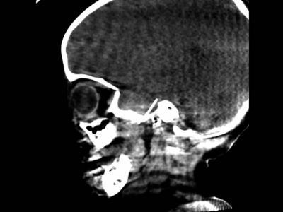 Niña de cuatro años se somete a una cirugía cerebral después de que una aguja de dentista penetrara en su cerebro