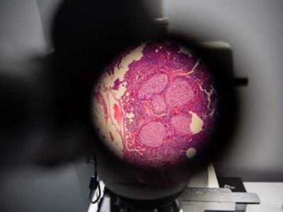 Iluminando la habilidad de las células cancerosas para desplazarse