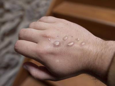 China refuerza fronteras por virus del mpox