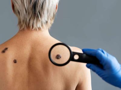 Melanoma: el cáncer de piel más peligroso