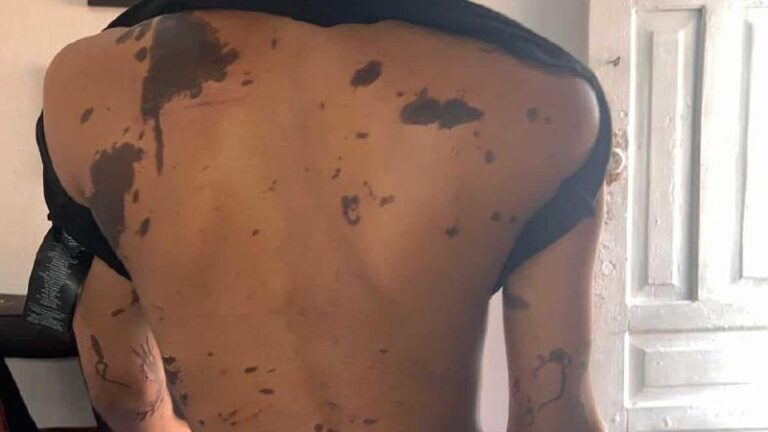 Atacan a madre e hija con ácido del diablo; acusan a hermanas de hombre denunciado por abuso sexual