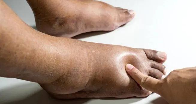 Alarma por pie diabético: más de 7,000 amputaciones anuales en República Dominicana
