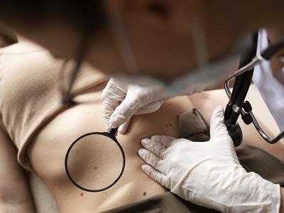 ¿Cuál es la diferencia entre pecas y lunares?